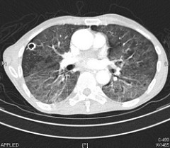 image of CT of lungs
